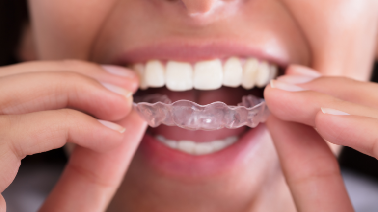 Dry Mouth Orthodontic Clear Aligners